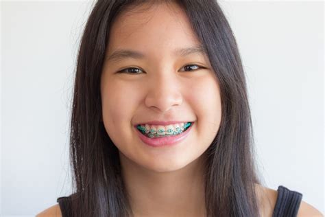 The Journey to a Beautiful Smile: A Real-Life Braces Transformation Story